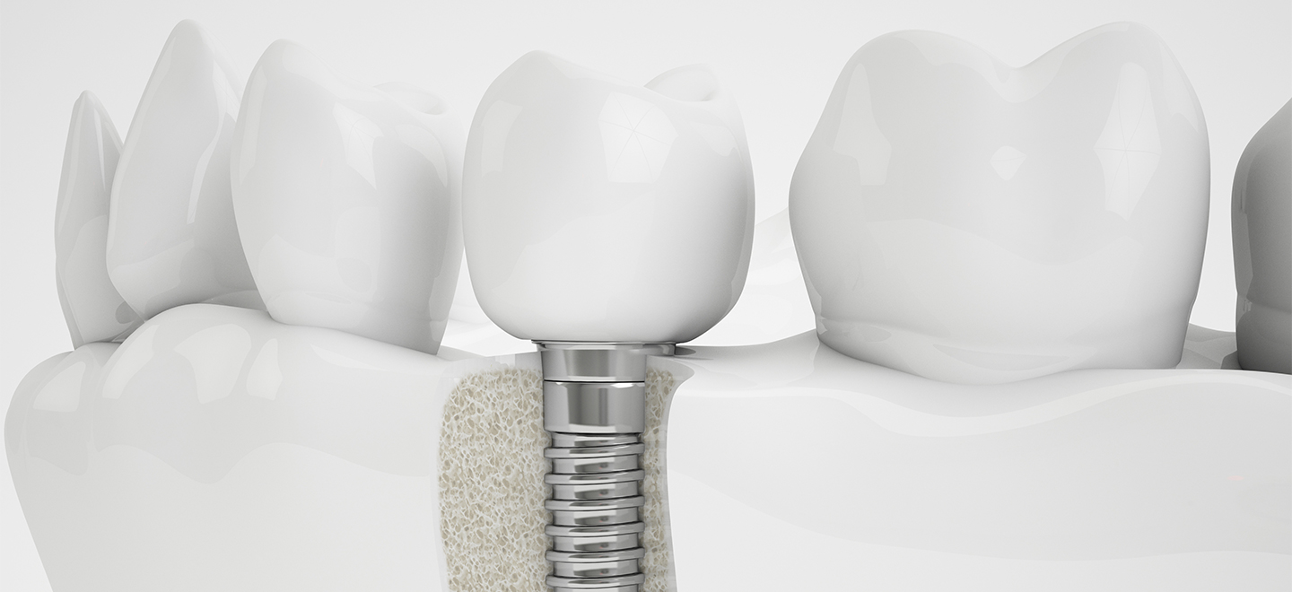 IMPLANTOLOGIE-1440x660