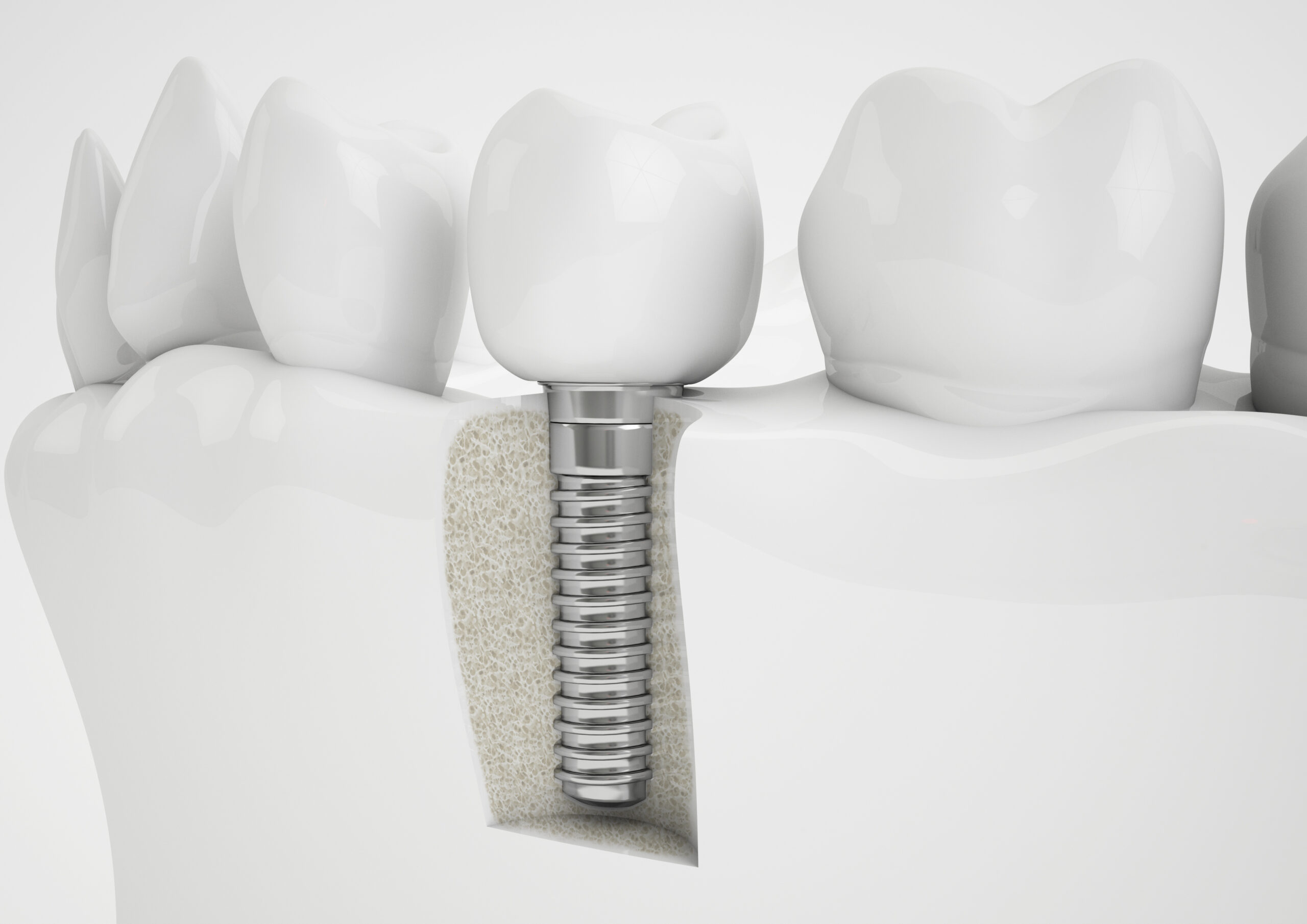 Zahnimplantat mit Knochenstruktur